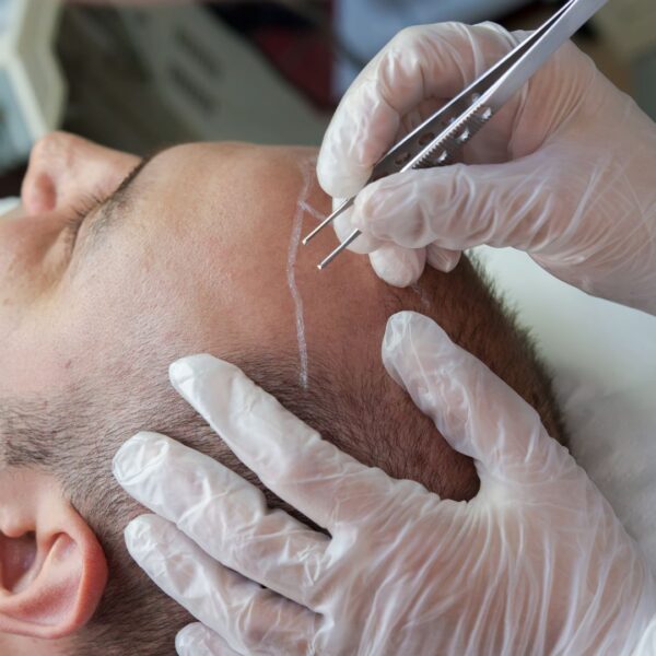 First stage of hair transplant on male head