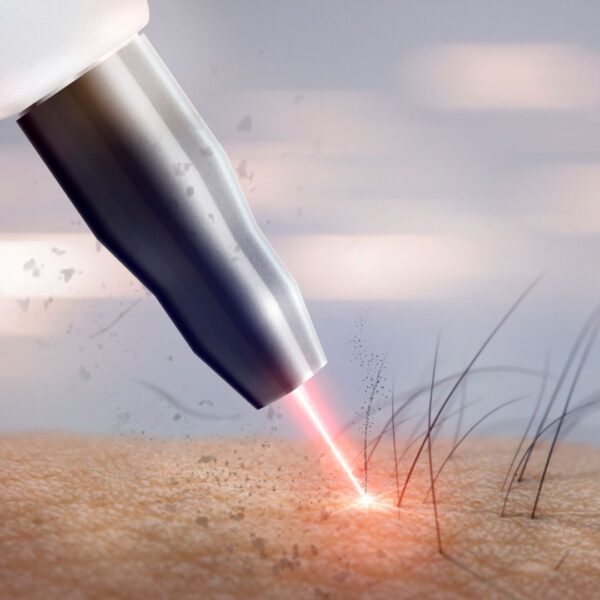 Descriptive image laser on a hair follicle