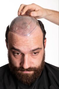 Hair Restoration Education