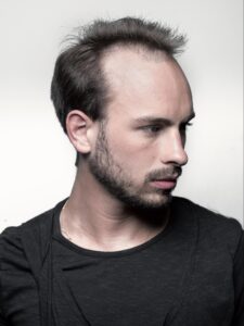 Hair Systems For Male Baldness
