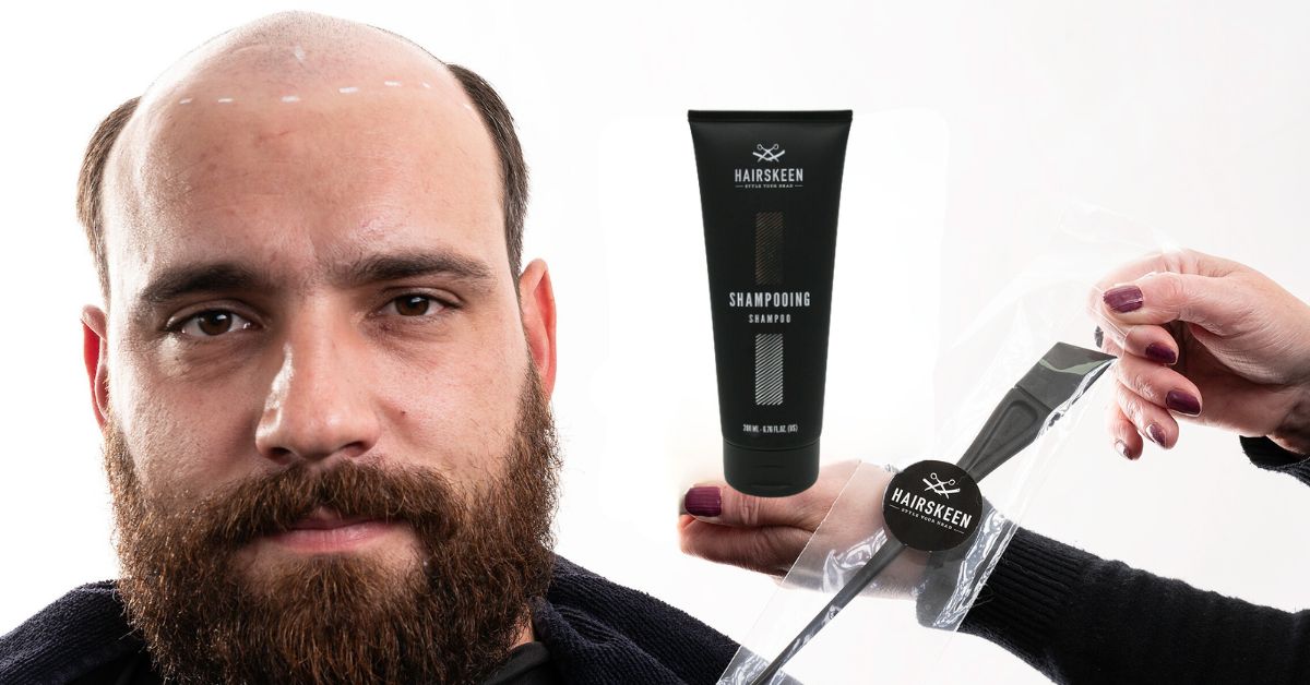 Troubled By Male Baldness