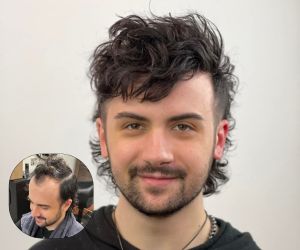 teen hair loss solutions