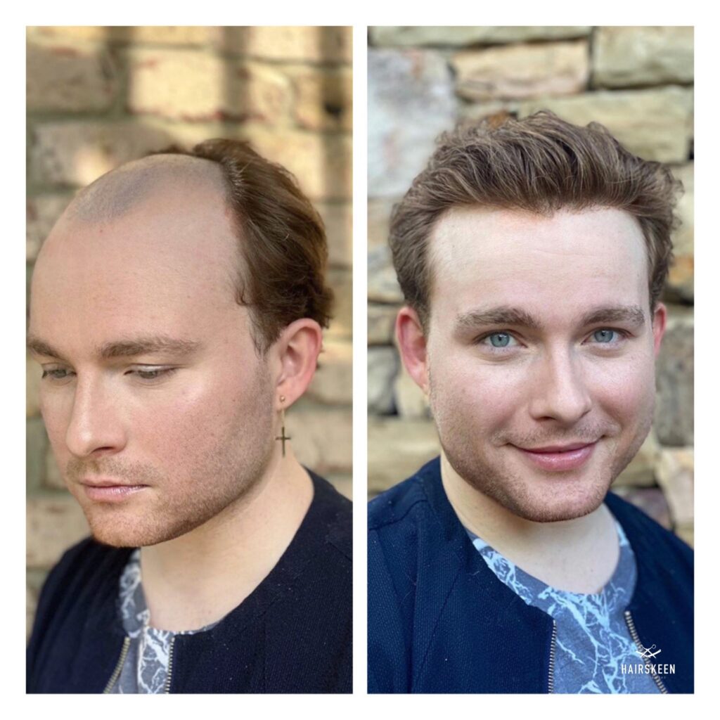 before and after hair replacement
