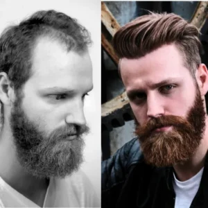 Before and after split image showing hair loss and man with full hair using Hairskeen Comfort hair replacement system