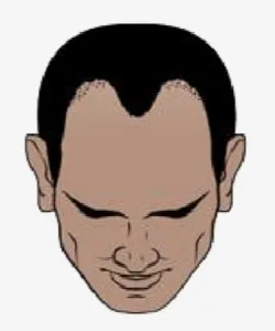 Hairskeen Frontskeen-a (2”x5”) male frontal hair system – size reference