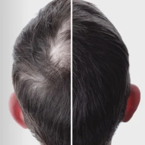 Before and after top-view split showing hair loss vs full hair coverage using Hairskeen Hair Fibers product