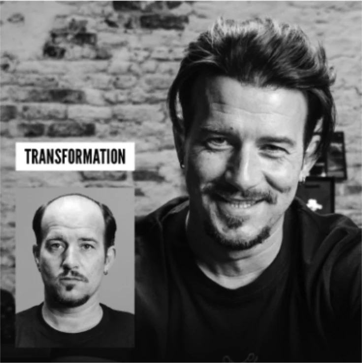 Black and white composite showing a man before (bald) and after (full, thick hair) with Hairskeen non-surgical hair replacement – transformation result 1