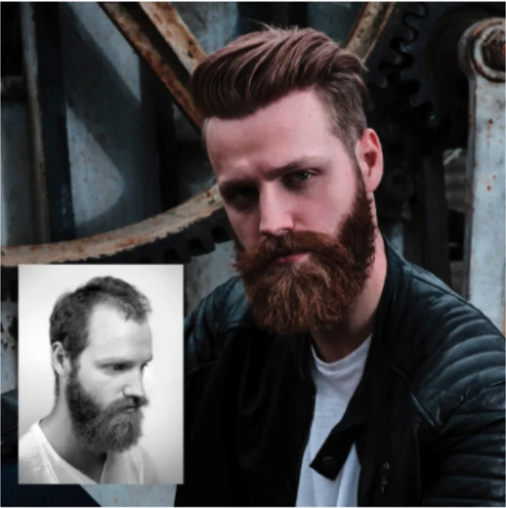 Before and after showing a bearded man with thinning hair before and full hair with a Hairskeen system – transformation result 2