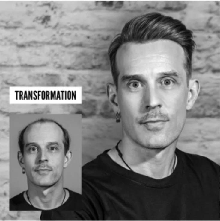 Hair replacement transformation result showing a man with hair loss before and natural-looking full hair after Hairskeen – result 3