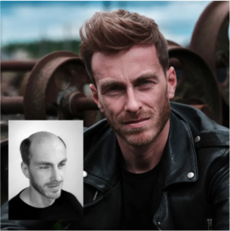 Hair replacement transformation showing man before with bald head and after with full natural hair using Hairskeen – result 4